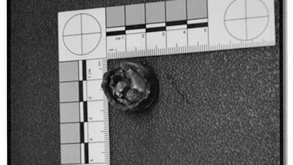 The piece of metal shrapnel removed from Mr Ngo's neck.