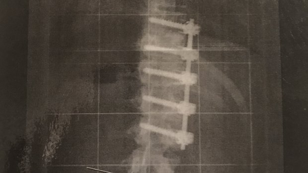 Featonby has a titanium rod and five screws in her spine as the result of severe scoliosis.