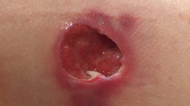 A Buruli ulcer affecting Mount Eliza primary school student Madeleine Danaher. The ulcer was about 7cm in diameter.
