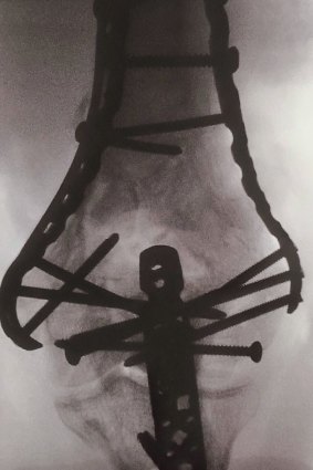 An x-ray of Viktor Vukovic's arm after a Lime scooter crash, showing the pins and plates after he broke it in three places.