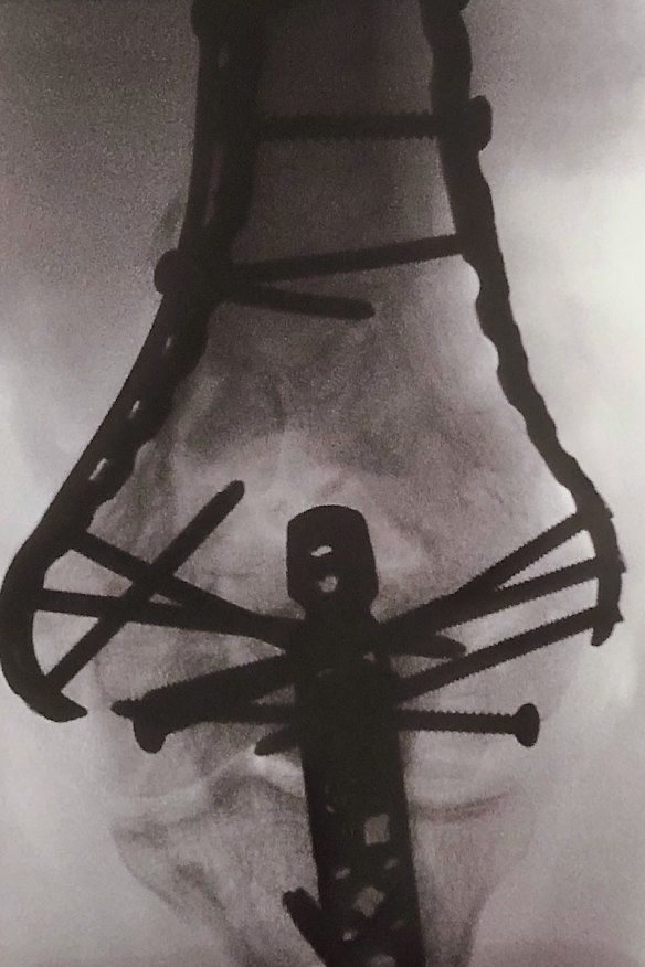 An x-ray of Viktor Vukovic's arm after a Lime scooter crash, showing the pins and plates after he broke it in three places.