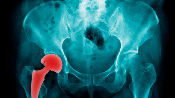 Hip replacement generic 