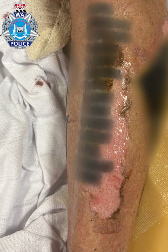 The burns on the man’s legs suggest others tried to burn off his Comanchero-related tattoos.