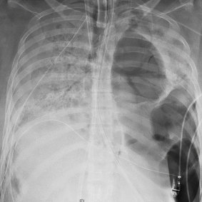 The patient's chest X-ray before she received a new set of lungs. 