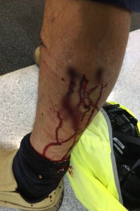 Another postie, whose leg was bitten by a dog. 