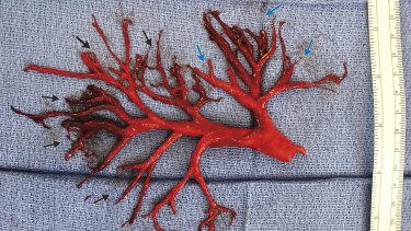 The blood clot that was coughed up by a patient.