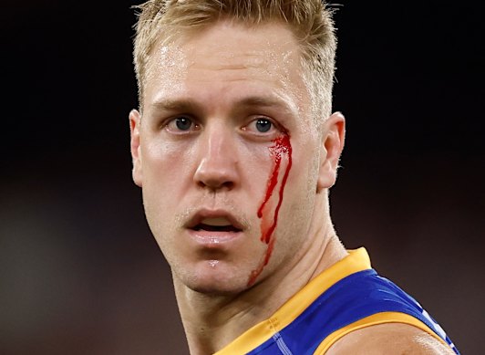 Oscar Allen leaves the field under the blood rule during Brisbane’s preliminary final win over Hawthorn.