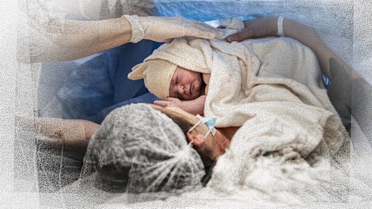 Forty-one per cent of Australian mothers now give birth by caesarean section.