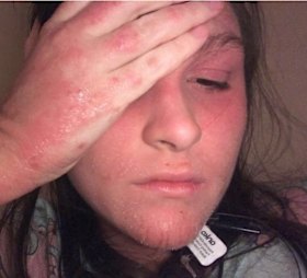 Lauren Rigby was admitted to Westmead Hospital earlier this year with erythroderma, a potentially life-threatening inflammation of the skin. 
