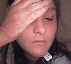 Lauren Rigby was admitted to Westmead Hospital earlier this year with erythroderma, a potentially life-threatening inflammation of the skin. 