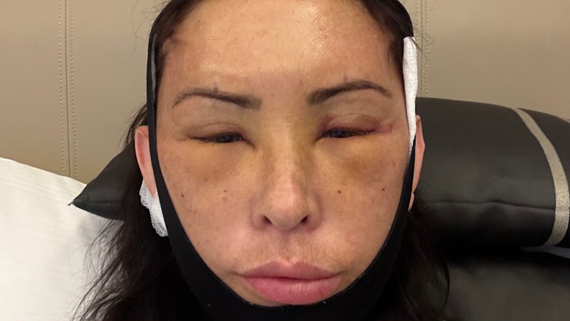 ?Snatched’ in Turkey: How a gory social media trend is fuelling a surge in cosmetic tourism