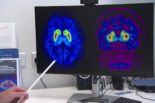 İlaç, Parkinson hastalığı riski yüksek bireylerde beyin iltihabını azaltma potansiyeline sahip.
