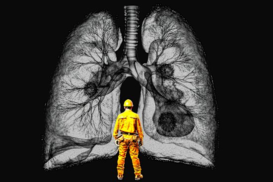 New research has estimated up to 300 workers across three tunnelling projects will be diagnosed with silicosis, an incurable lung disease.