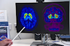 The drug has potential to reduce inflammation in the brain of people at high risk of Parkinson’s disease.