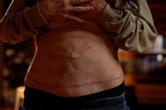 A woman’s stomach after surgery at Dr Daniel Lanzer’s clinic.