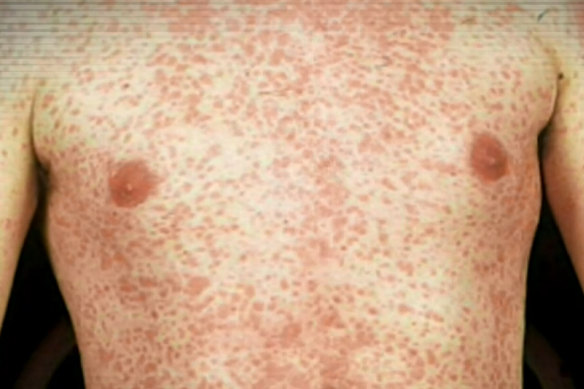 Measles comes with a painful rash.