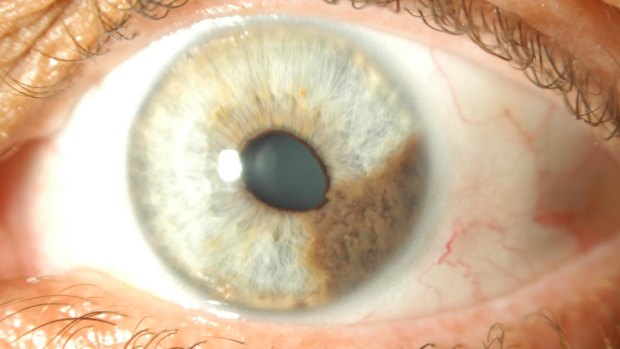 An example of a uveal or eye melanoma forming on the iris.