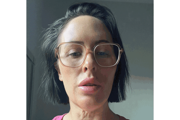 smh.com.au - Melissa Cunningham - 'Snatched' in Turkey: How a gory social media trend is fuelling a surge in cosmetic tourism