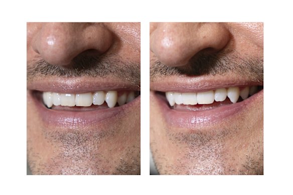 Jean Carre’s teeth before and after whitening.