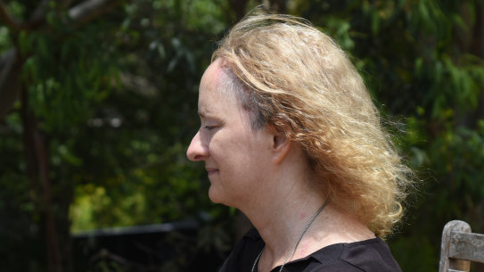 Susan Cohen used two different types of black salve on skin cancers on her scalp and forehead. 