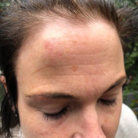 Emma Walters, wife of union leader John Setka, says she was assaulted by him. These are the images of her head injury
