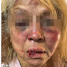 A 73-year-old woman was seriously injured in the robbery. Police released an un-edited picture of the woman to convey to the public the violent and unprovoked nature of the attack