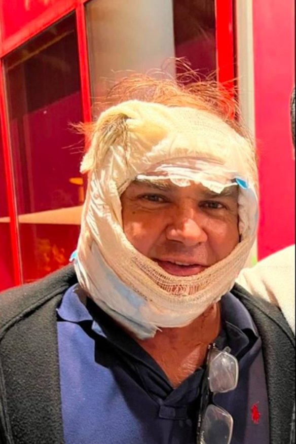 Nick Petroulias, photographed after a facelift procedure in Lebanon.