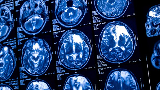 There is currently no cure for Huntington’s, a fatal neurodegenerative disease caused by a single genetic mutation. But scientists in the UK have achieved a massive breakthrough.