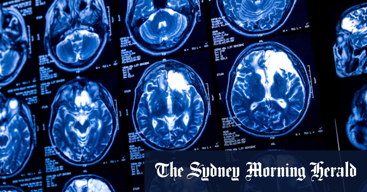 UK scientists slow Huntington’s disease for first time