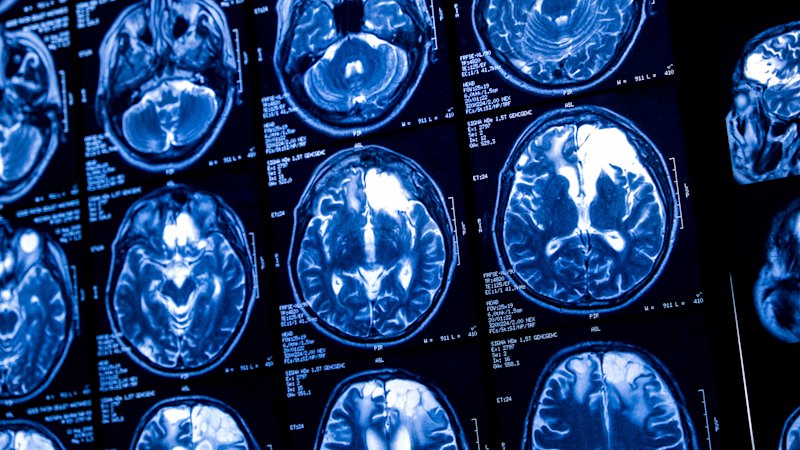 UK scientists slow Huntington’s disease for first time