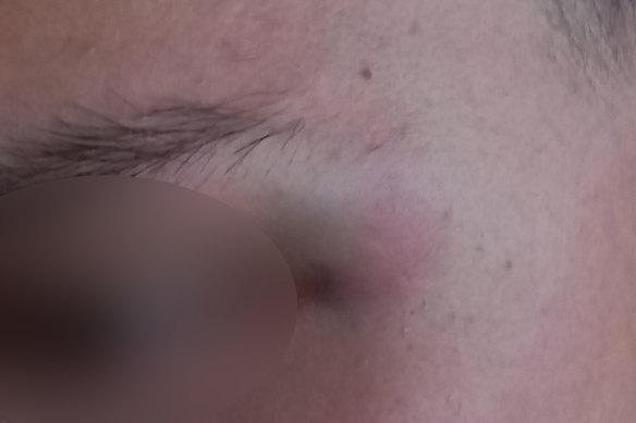 The teen’s bruises after he was assaulted at a Chadstone Shopping Centre food court on February 24.
