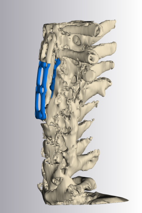 A 3D model of Frecklington’s neck vertebrae with the metal appliance in blue.