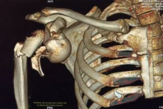 A medical scan showing Nik Dimopoulos' injuries.