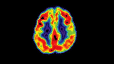 Dementia research advances prompt “breakthrough” claims on blood tests and treatments