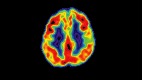 After records of disappointment, thee is finally some good news dementia reseach.