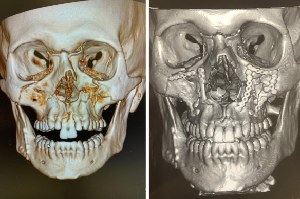 Chris Lawrence's X-ray prior to surgery (left) and after surgery with plates and pins inserted (right).