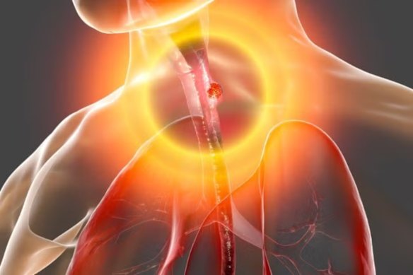 :  Trials of Proteomics International’s PromarkerEso blood test have delivered a near-perfect score for the detection of throat cancer across all stages of the disease.