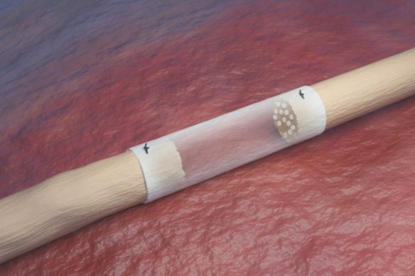 A principal pulseira nervosa NerveAlign da ReNerve conseguiu um contrato monstruoso com o Departamento de Defesa e Assuntos de Veteranos dos EUA.