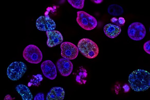  This image is a close-up micrograph of human colorectal cancer cells captured using fluorescence microscopy