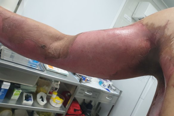 Wang’s arm after the blisters faded.