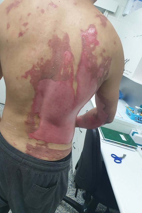 The burns to Wang’s back.