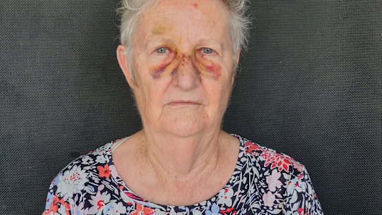 Brisbane resident Robyn Abell was knocked over by someone on an escooter while she was on her way to meet family at the local markets in West End.
