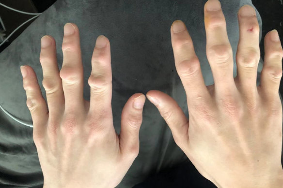 Arthritis in the fingers of a Chinese meatworker who has worked for five years at Midfield Meats.