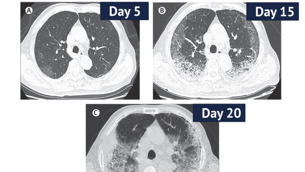 CT scans from a 77-year-old man with COVID-19 in China over 10 days, showing ground-glass opacity of the lungs and lesions. 
The man died 10 days after the final scan.