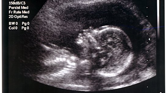 'We need to know the sex. If it’s a girl we are going to terminate it'