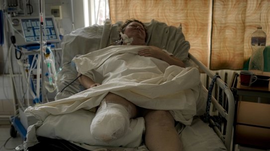 A woman whose leg had to be amputated after she suffered gunshot wounds in a village currently under the control of the Russian military, lies in an intensive care unit at a hospital in Brovary, north of Kyiv, Ukraine.