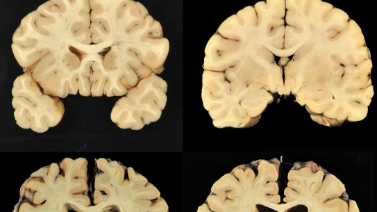 This combination of photos provided by Boston University shows sections from a normal brain, top, and from the brain of former University of Texas football player Greg Ploetz.