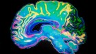 Epi-Minder's monitoring system is implanted under a patient's scalp and is designed to help predict epileptic seizures more accurately.