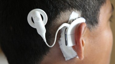 "Earlier cochlear implantation for children born with hearing loss leads to them obtaining age-appropriate speech and language faster than delayed implantation," says Cochlear CEO Dig Howitt.