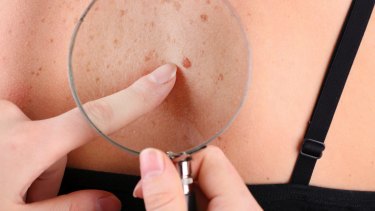 The Australasian College of Dermatologists warns there is a shortage of skin cancer specialists in the country with the highest rate of melanoma in the world.